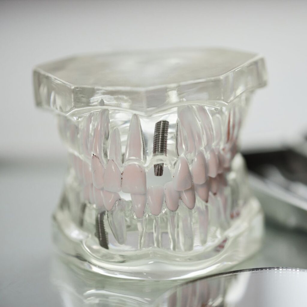 e implantes dentales