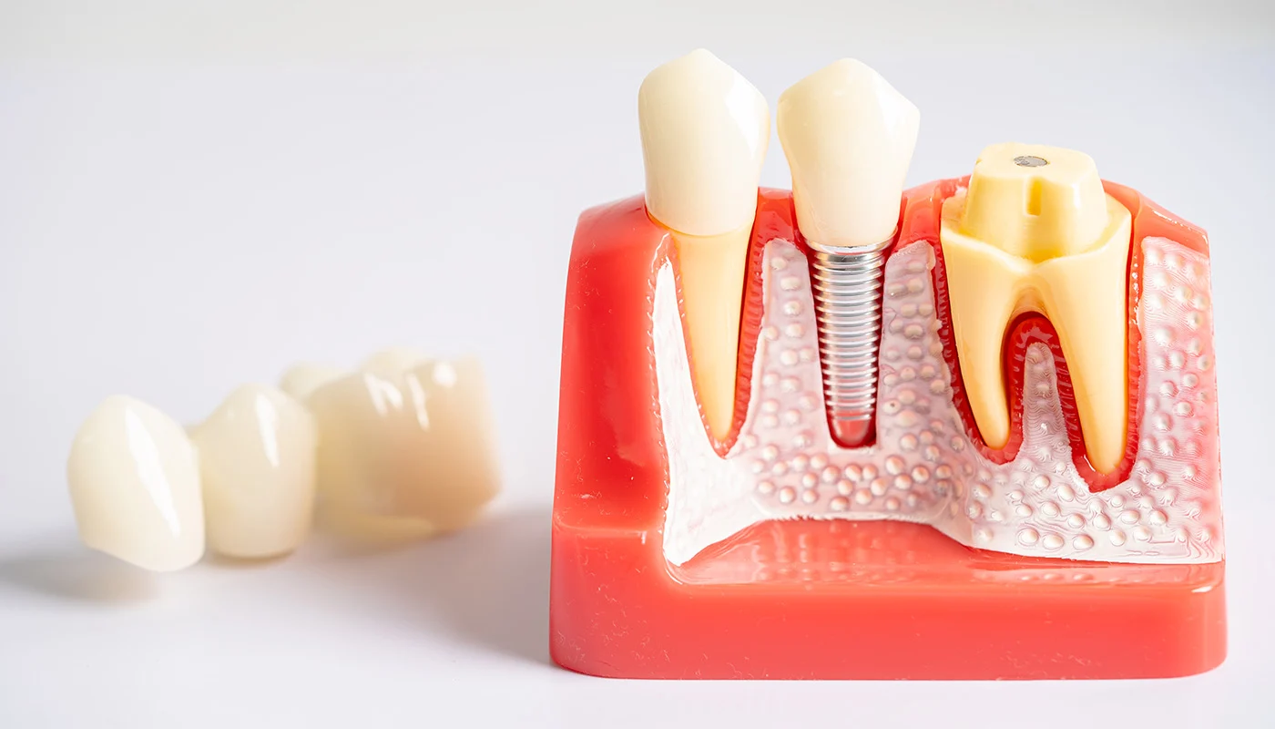 rehabilitacion sobre implantes